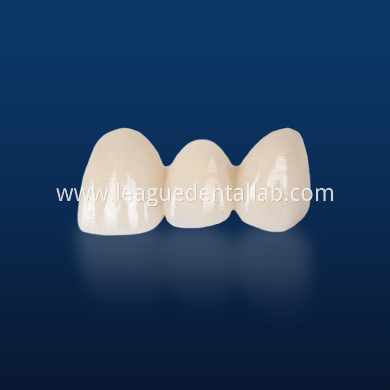 PFM,Metal crown,Fixed metal crown PFM,Metal crown,Fixed metal crown